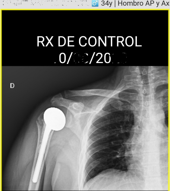 radiografía protesis de hombro